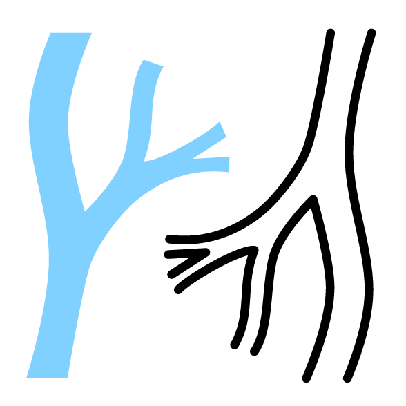 Beroerte