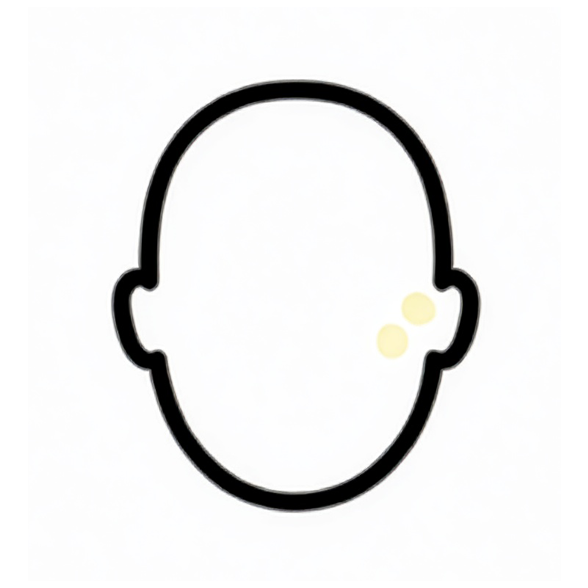 Alopecia androgenetica